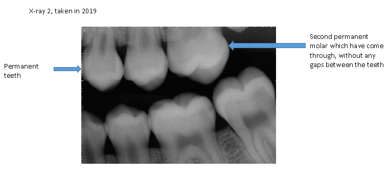 A Case Study-Sometimes Extraction is the Best Option