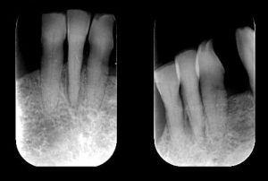 Periapical x-rays