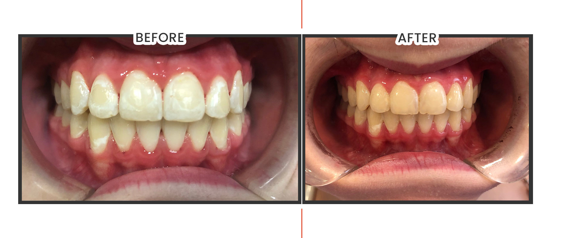 What Can I Do With The White Spots On My Tooth?