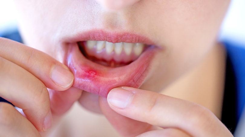 Cold Sores | Caulfield South Dental